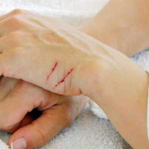 Ogrtačine na rukama: uzroci, liječenje, pripreme. Krem `Rescuer`: upute za uporabu