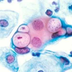 Chlamydia trachomatis. Što je to i koje bolesti uzrokuju?