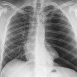 Što prikazuje X-ray? Kompetentno tumačenje rendgenskog zračenja pluća