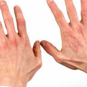 Što je dermatitis? Kako liječiti dermatitis?