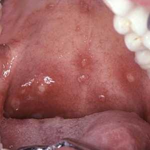 Što je herpes upala grla kod djece? Od liječenja infekcije?