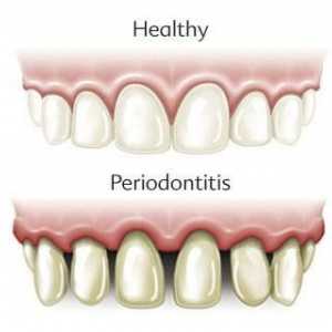 Što je parodontitis? Razvrstavanje i liječenje