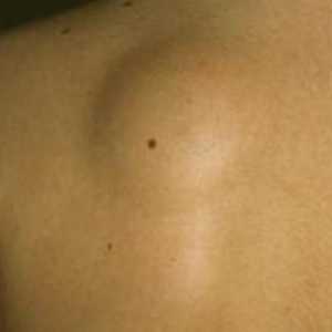 Što je kvržica na leđima blizu kralježnice i kako je izliječiti?
