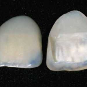 Što su rezane na zubima? Podstava za zube - veneers