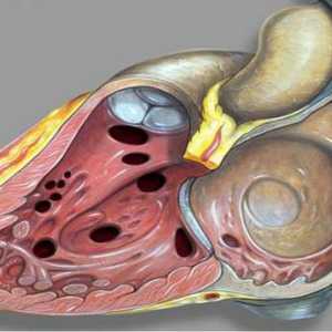 Poremećaj intervencijskog septuma. DMF za fetus: uzroci, dijagnoza i posljedice