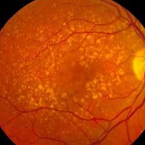 Degeneracija makularne retine: simptomi i liječenje
