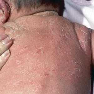 Exfoliativni dermatitis kod odraslih i novorođenčadi (fotografija)