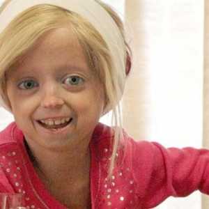 Dječja progeria: da li djeca imaju priliku?