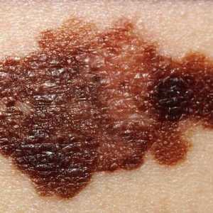 Dijagnoza melanoma kože: metode, recenzije