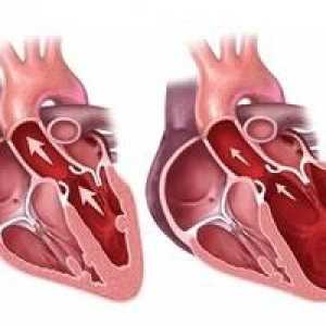 Diastolička disfunkcija lijeve klijetke srca. Opis. liječenje