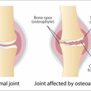 Dijeta za artroze zglobova koljena: preporuke