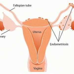 "Dyufaston" u endometriozi - recenzije. Učinkovitost "Dyufaston", cijena