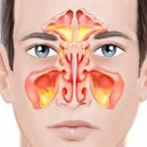 Bilateralni sinusitis: simptomi i liječenje
