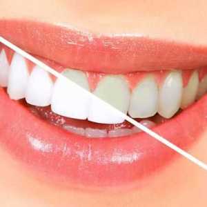 Fluorizacija zuba - što je to? Kako se provodi postupak dubokog fluoriranja zuba?