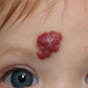Hemangioma lica: uzroci i liječenje. Hemangioma na licu u odraslih i djece