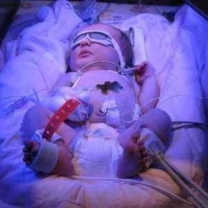Hemolitička bolest novorođenčadi: uzroci i liječenje