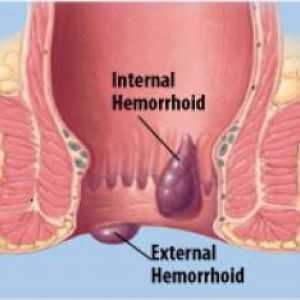 Hemoroidi nakon isporuke: liječenje dojenjem. Koja sredstva mogu podnijeti zahtjev?