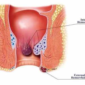 Hemoroidi: uzroci muškaraca, simptomi i karakteristike liječenja