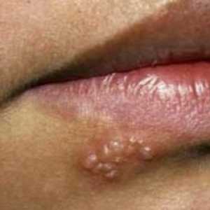 Herpes na usnama: kako se prenosi? Lijek za herpes na usnici. Je li herpes opasno?