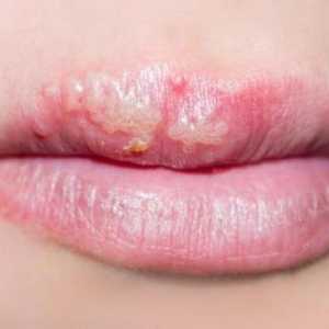 Herpes na usnama: kako se zauvijek izliječiti pučkim lijekovima? Je li moguće zauvijek izliječiti…