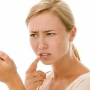 Herpes na usnama: liječenje kod kuće. Kako brzo izliječiti herpes na usnama kod kuće?