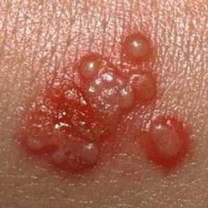 Herpes genitalije: uzroci i liječenje