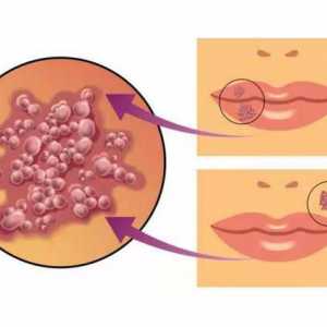 Herpes u djece na usnama: značajke i uzroci