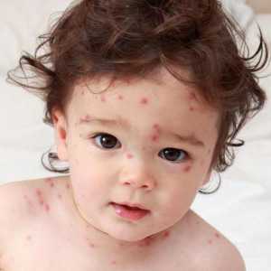 Herpes u djetetu: vrste, simptomi i liječenje