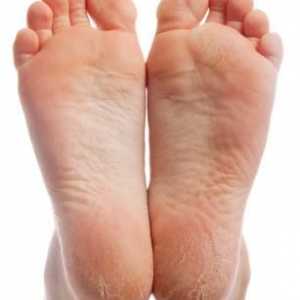 Hiperkeratoza stopala: liječenje narodnim lijekovima