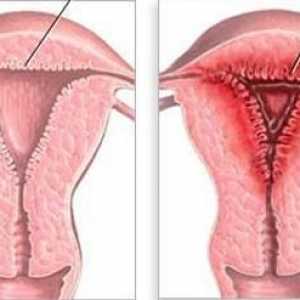 Hiperplazija endometrija: što je to? Uzroci, simptomi i metode liječenja