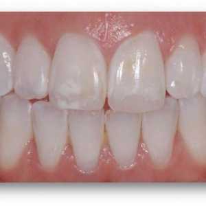 Hipoplazija zubne cakline: dijagnoza i liječenje