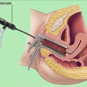Histeroskopija maternice - što je to? Histeroskopija maternice: vrste, indikacije, trošak postupka