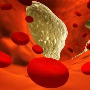 Kolesterol LDL povećao se: kako smanjiti i koja je njena norma?