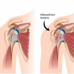 Impingment-sindrom ramenog zgloba: liječenje, uzroci, dijagnostika