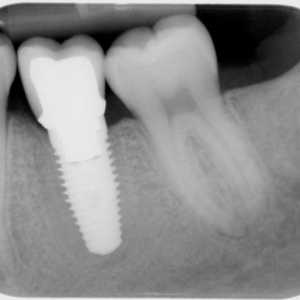 Implantacija zuba: kontraindikacije i moguće komplikacije (recenzije)