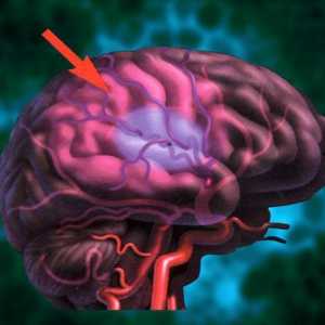 Moždani udar mozga: prevencija. Folk lijekovi za prevenciju moždanog udara