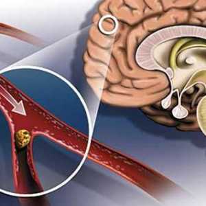 Moždani udar: znakovi i posljedice. Glavni simptomi moždanog udara i mikro moždanog udara