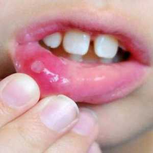 Djelotvorni antibiotici za stomatitis kod djece