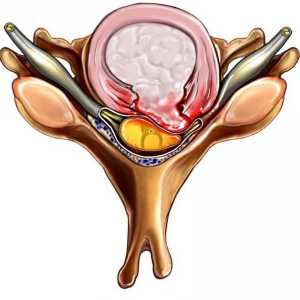 Ekstrudiranje je bolest intervertebralnih diskova. Vrste ekstruzije. Metode liječenja