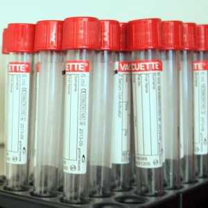 Elektroforeza krvnih proteina