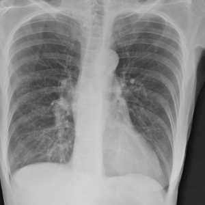 Emfizem pluća: liječenje i prognozu