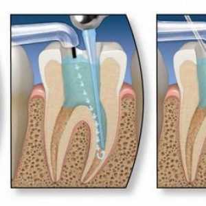 Endodontsko liječenje zuba. Faze endodontskog liječenja