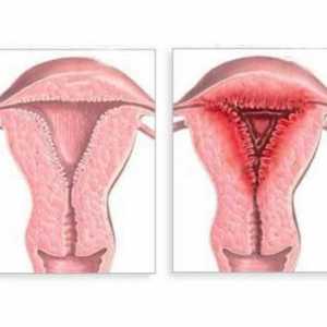 Endometritis: što je to? Uzroci, simptomi i liječenje bolesti