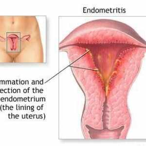 Endometrit maternice - što je to? Simptomi endometritisa kod žena. Ginekologija - endometritis
