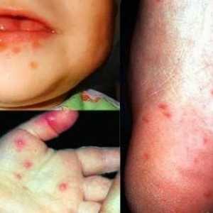 Infekcija enterovirusom kod djeteta: liječenje, simptomi, prevencija