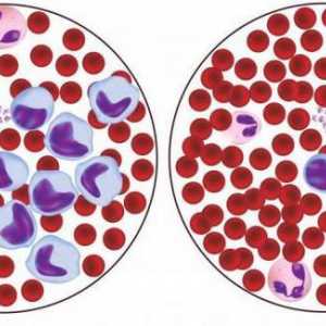 Spuštaju se eritrociti u krvi: mogući uzroci