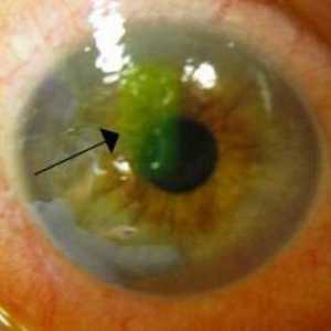 Erozija kornea u oku: simptomi, uzroci i liječenje