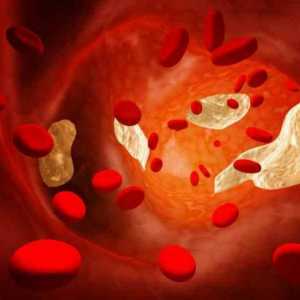 Kako se riješiti kolesterola? Kako očistiti krvne žile od kolesterola?