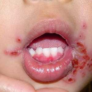 Kako liječiti stomatitis kod djeteta?
