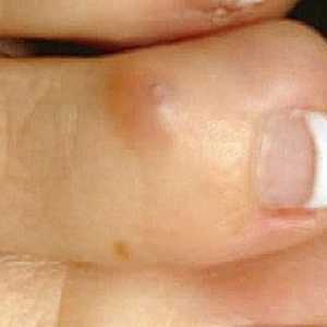 Kako postupati sa suhim kaltizom na nožni prst? Žbuka na suhim kukcima